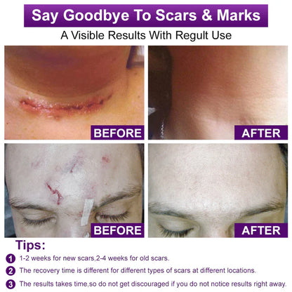 💙 TGA-Certified ✅Misspone® Scar Gel – Clinically Proven to Fade Surgical, Acne, Burn & Trauma Scars
