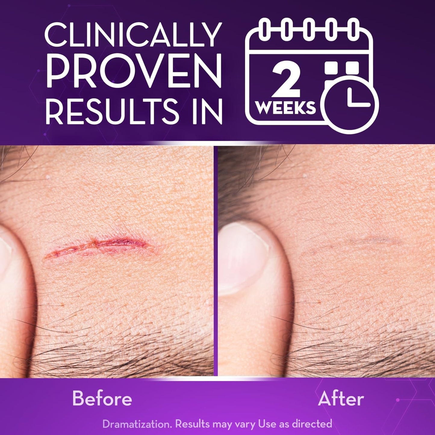 💙 TGA-Certified ✅Misspone® Scar Gel – Clinically Proven to Fade Surgical, Acne, Burn & Trauma Scars
